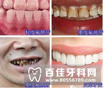 氟斑牙种类有哪些？